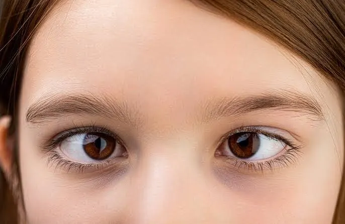 Squint (Strabismus)